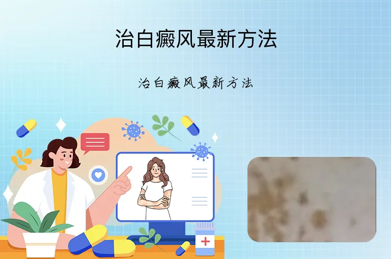 治白癜风最新方法