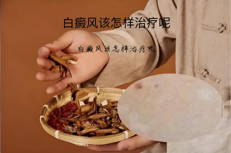 白癜风该怎样治疗呢