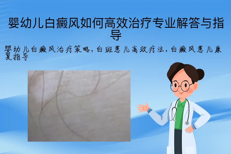 婴幼儿白癜风如何高效治疗专业解答与指导
