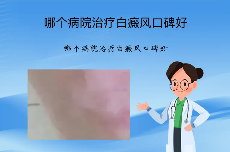 哪个病院治疗白癜风口碑好