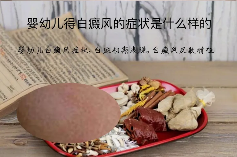 婴幼儿得白癜风的症状是什么样的
