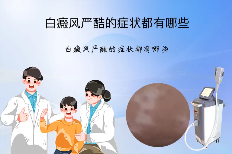 白癜风严酷的症状都有哪些