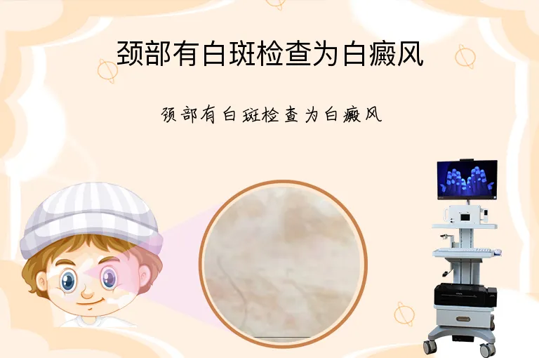 颈部有白斑检查为白癜风