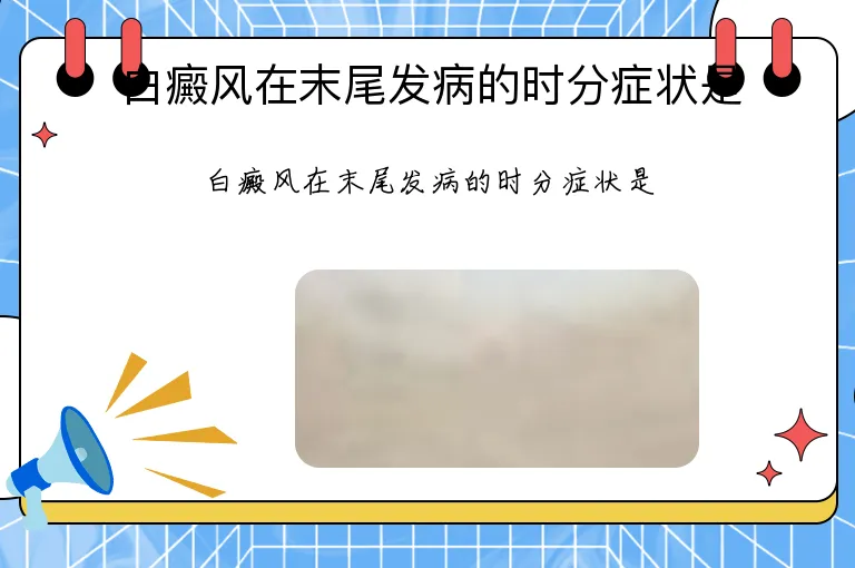 白癜风在末尾发病的时分症状是