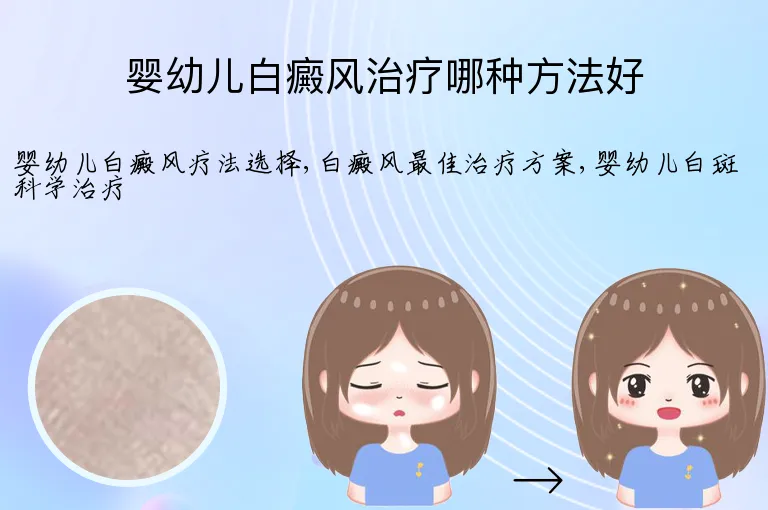 婴幼儿白癜风治疗哪种方法好