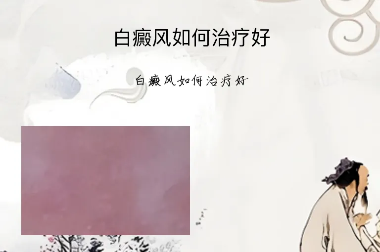 白癜风如何治疗好