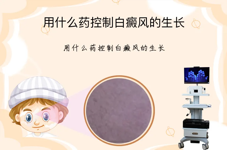 用什么药控制白癜风的生长