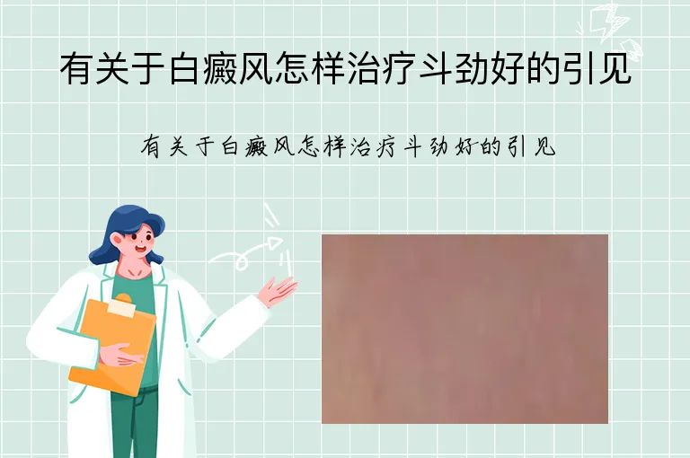 有关于白癜风怎样治疗斗劲好的引见