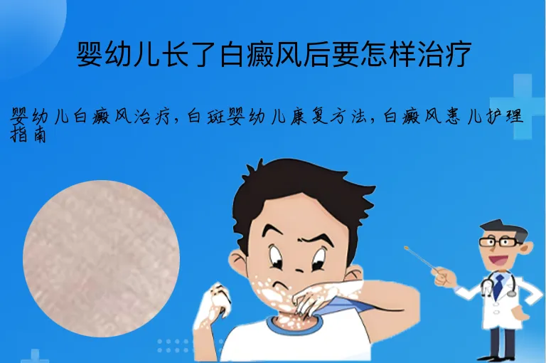 婴幼儿长了白癜风后要怎样治疗