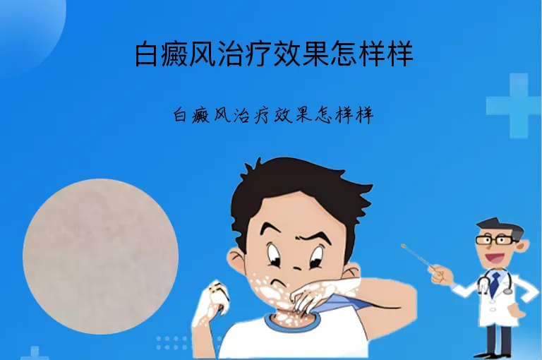 白癜风治疗效果怎样样