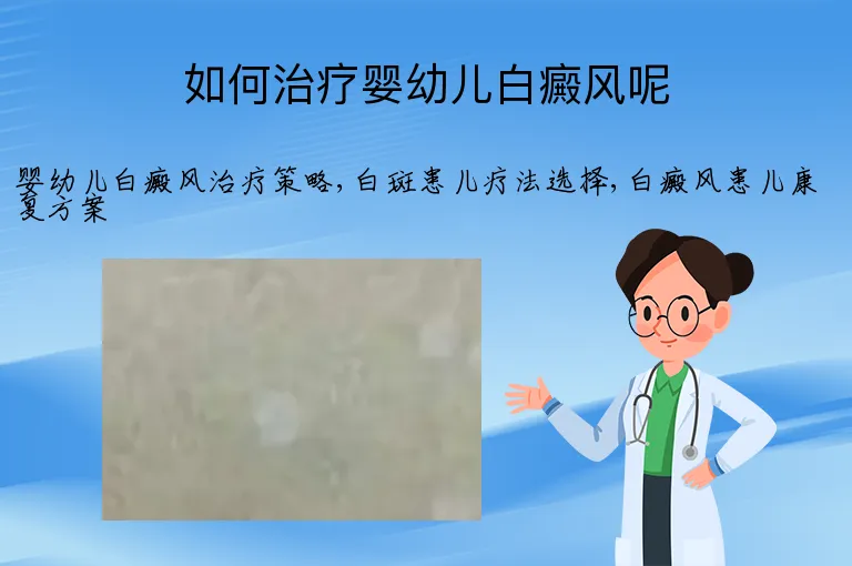 如何治疗婴幼儿白癜风呢