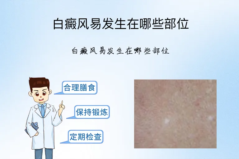 白癜风易发生在哪些部位