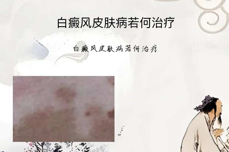 白癜风皮肤病若何治疗