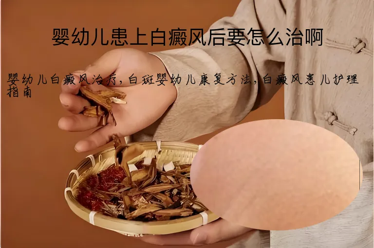 婴幼儿患上白癜风后要怎么治啊