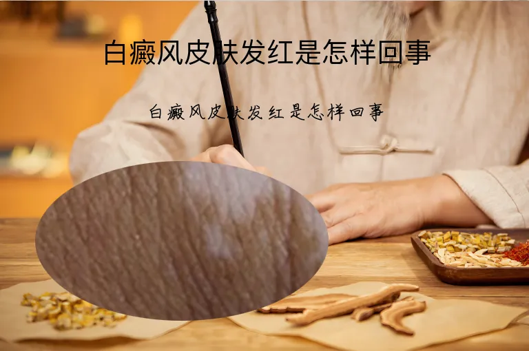 白癜风皮肤发红是怎样回事