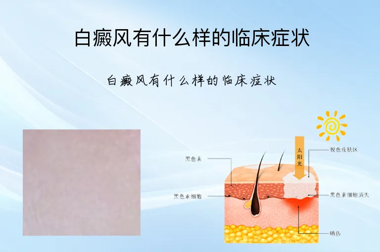 白癜风有什么样的临床症状