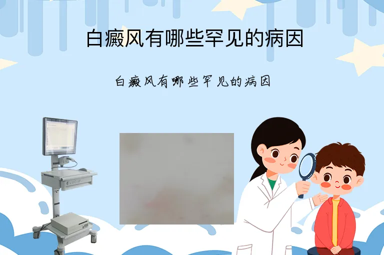 白癜风有哪些罕见的病因