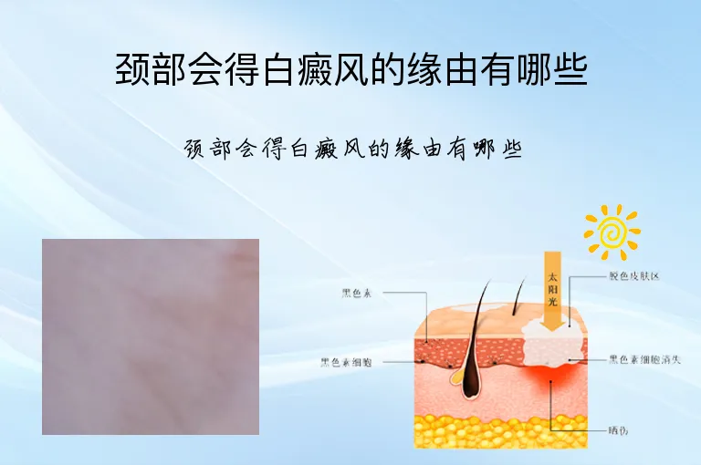 颈部会得白癜风的缘由有哪些