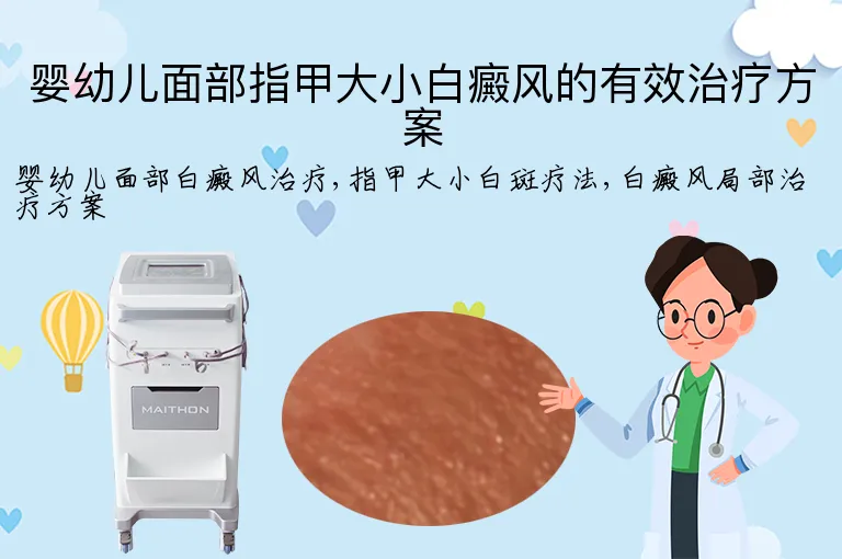 婴幼儿面部指甲大小白癜风的有效治疗方案