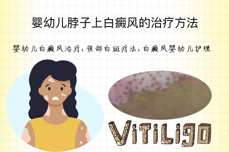 婴幼儿脖子上白癜风的治疗方法