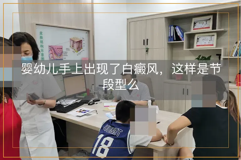 婴幼儿手上出现了白癜风，这样是节段型么