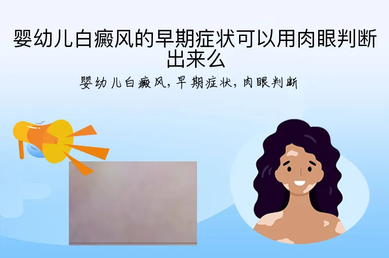 婴幼儿白癜风的早期症状可以用肉眼判断出来么