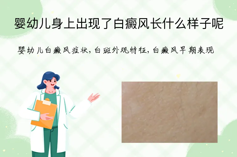 婴幼儿身上出现了白癜风长什么样子呢