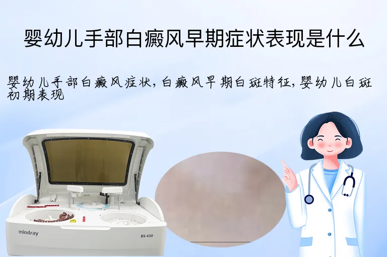 婴幼儿手部白癜风早期症状表现是什么