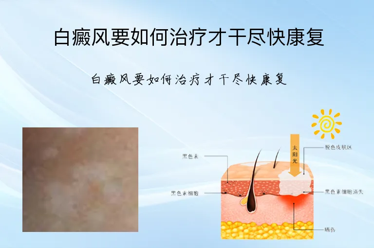 白癜风要如何治疗才干尽快康复