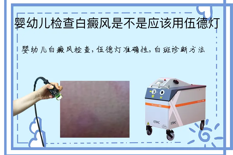 婴幼儿检查白癜风是不是应该用伍德灯