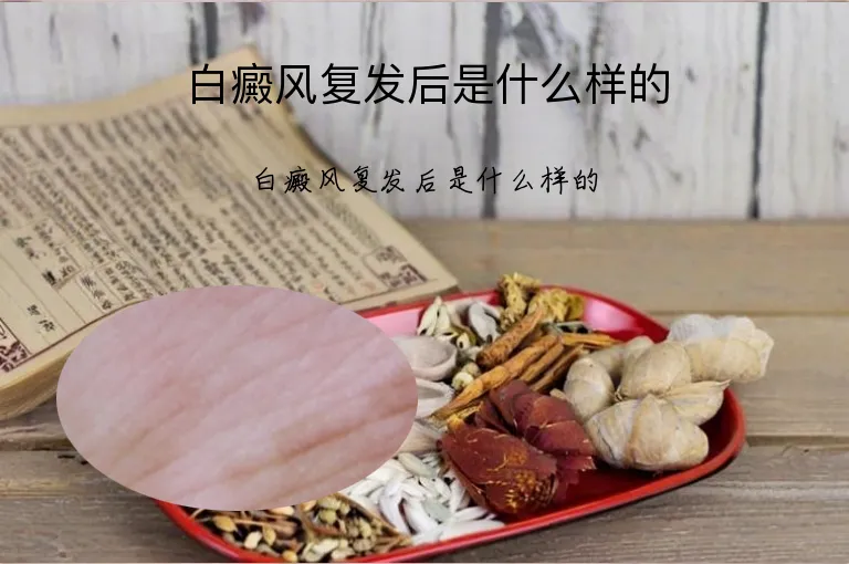 白癜风复发后是什么样的