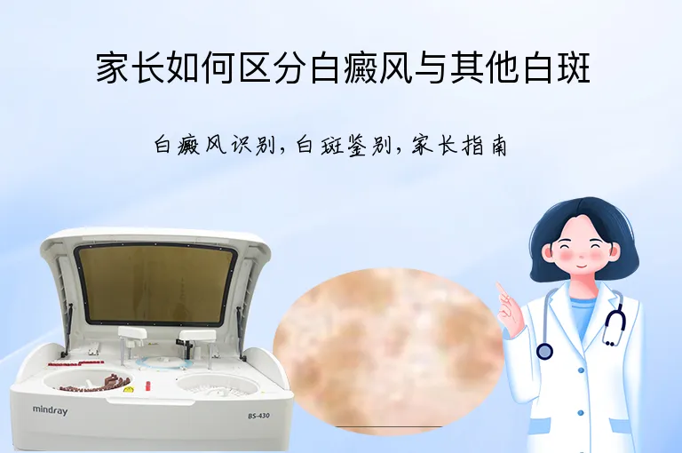 家长如何区分白癜风与其他白斑