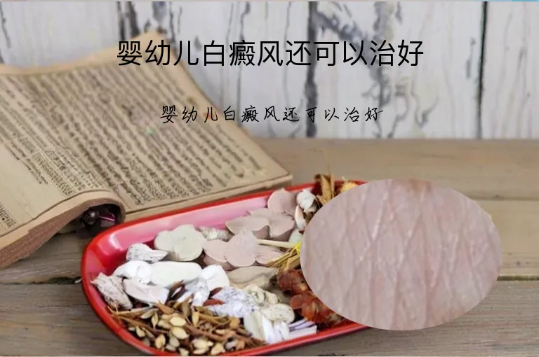 婴幼儿白癜风还可以治好