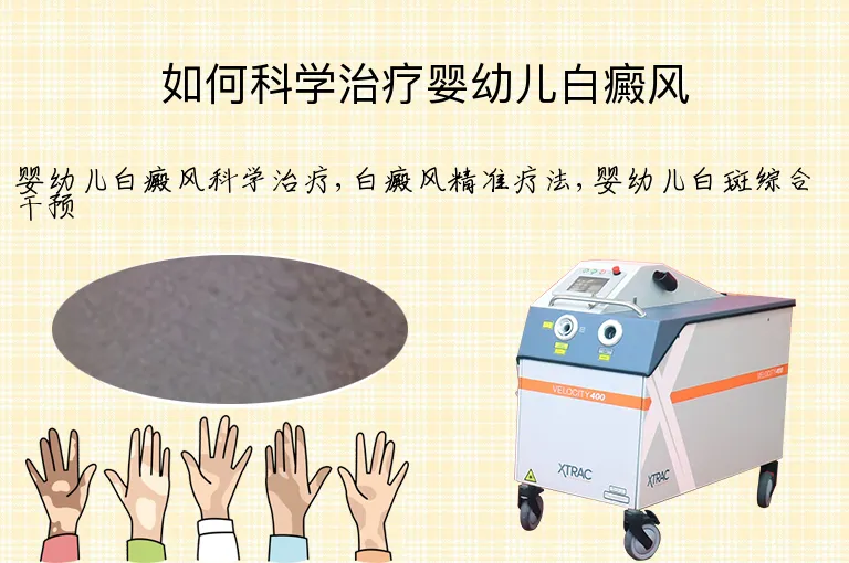 如何科学治疗婴幼儿白癜风