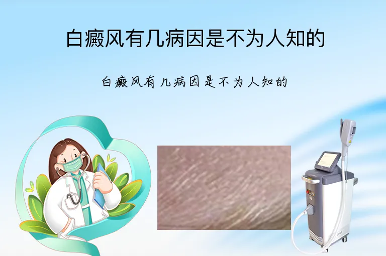 白癜风有几病因是不为人知的