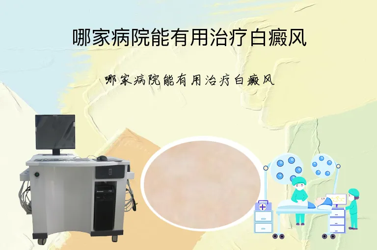 哪家病院能有用治疗白癜风