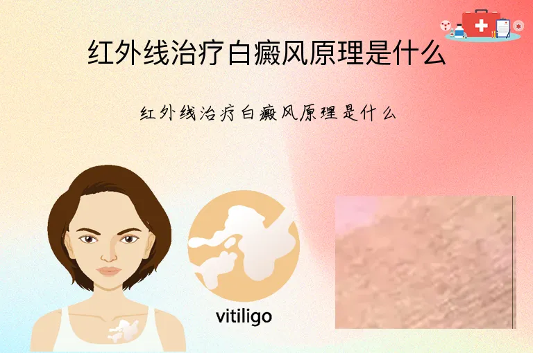 红外线治疗白癜风原理是什么