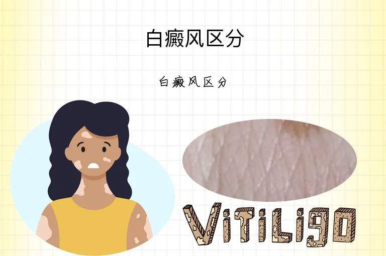 白癜风区分