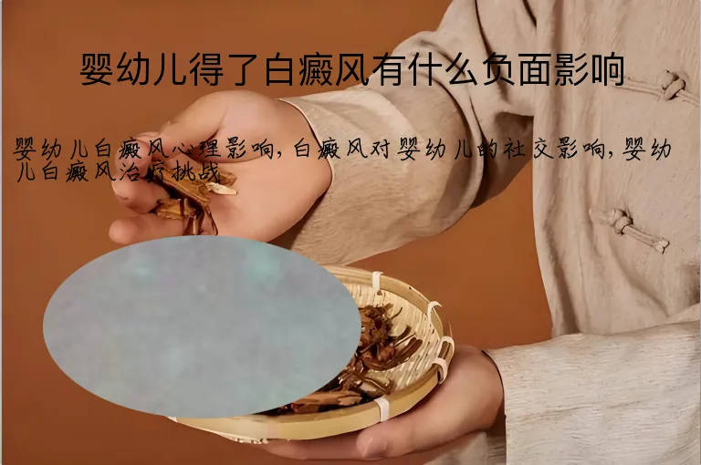 婴幼儿得了白癜风有什么负面影响