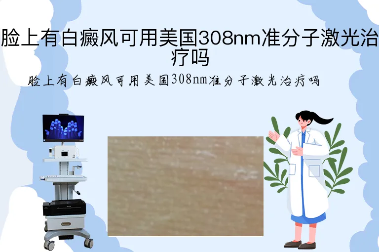 脸上有白癜风可用美国308nm准分子激光治疗吗
