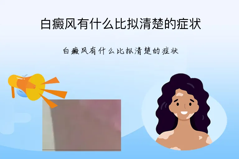 白癜风有什么比拟清楚的症状