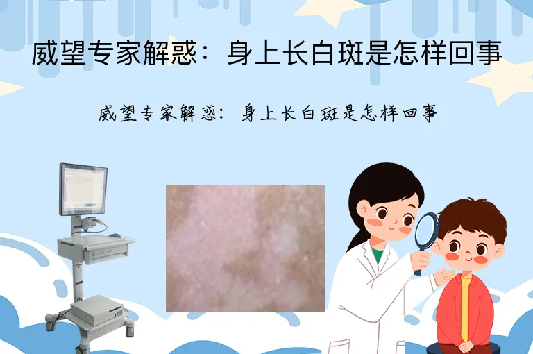 威望专家解惑：身上长白斑是怎样回事