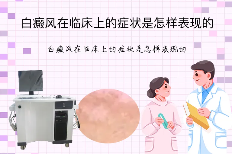 白癜风在临床上的症状是怎样表现的