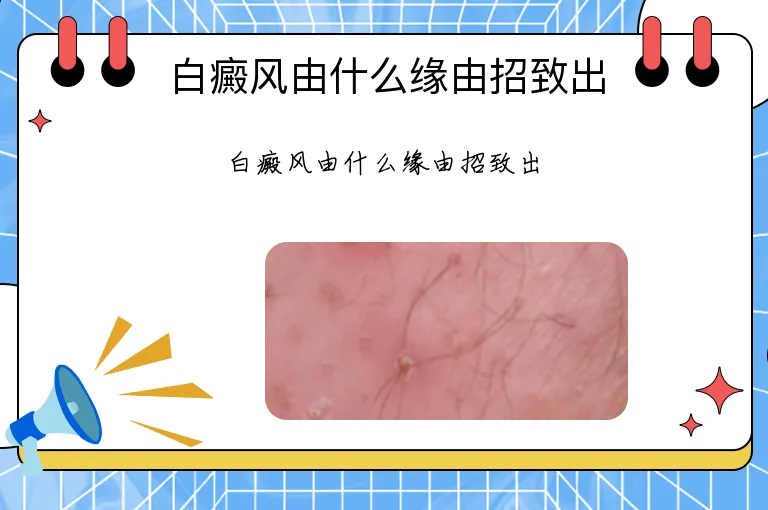 白癜风由什么缘由招致出