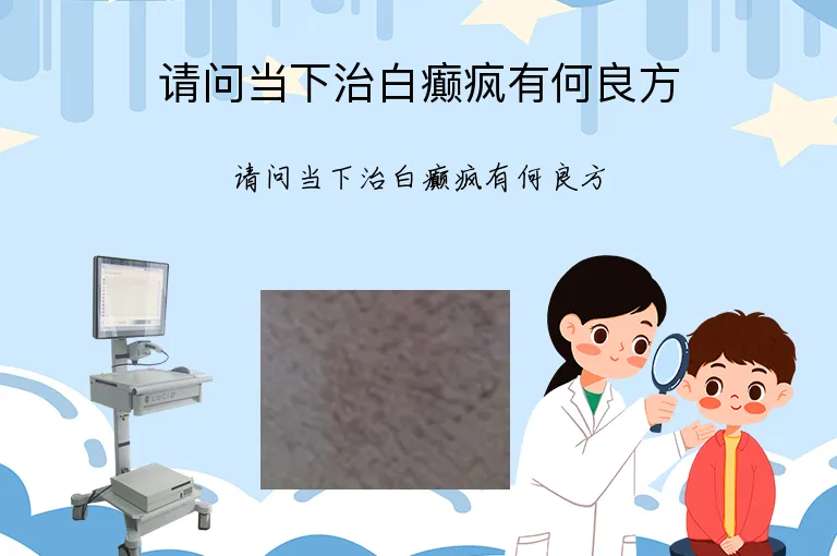 请问当下治白癫疯有何良方