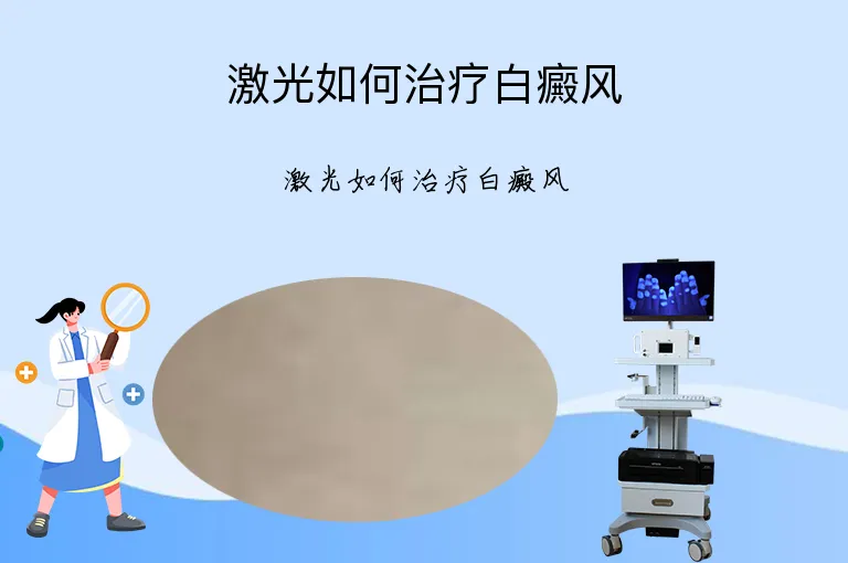 激光如何治疗白癜风