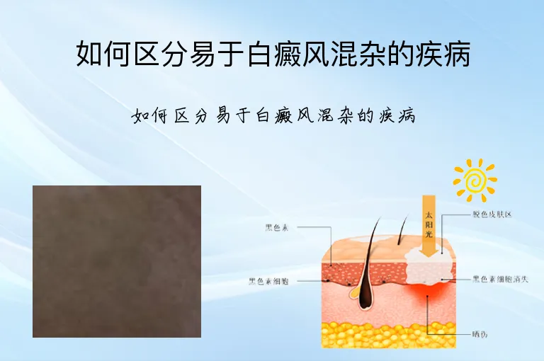 如何区分易于白癜风混杂的疾病