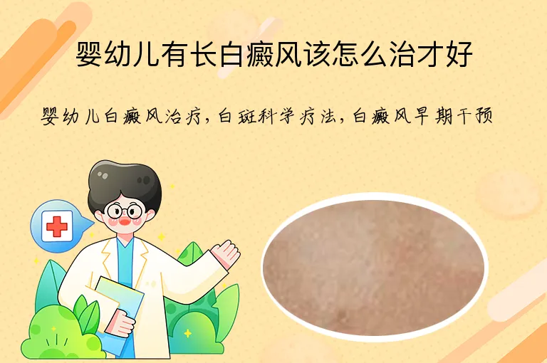 婴幼儿有长白癜风该怎么治才好