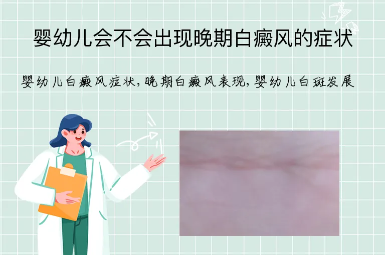 婴幼儿会不会出现晚期白癜风的症状