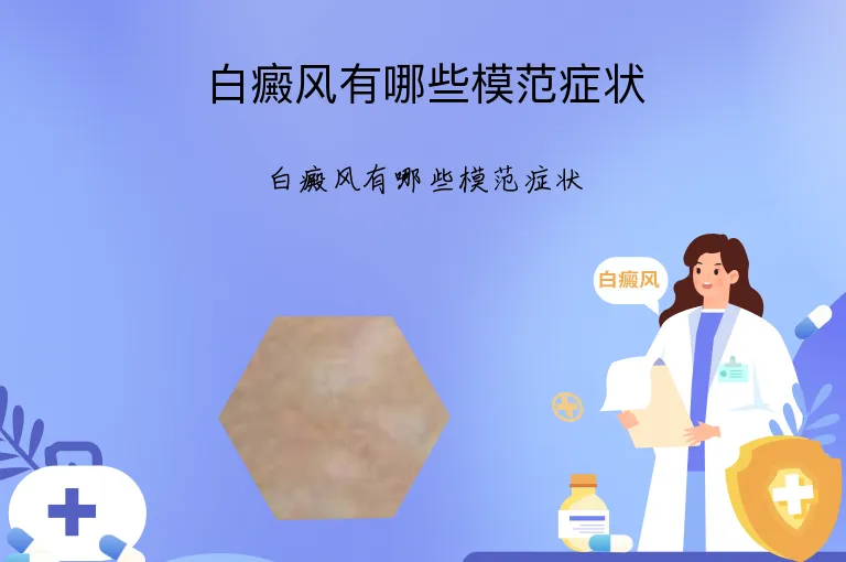 白癜风有哪些模范症状